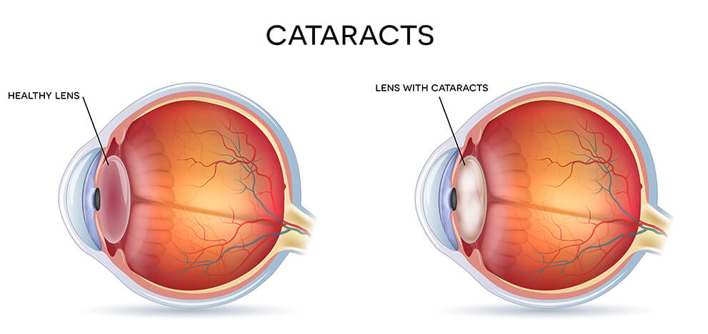 Cataract