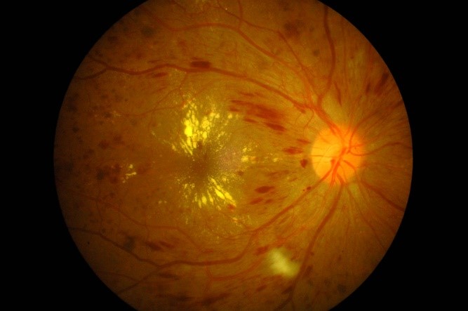 Diabetic eye care