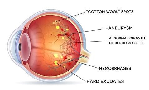 Diabetic Retinopathy