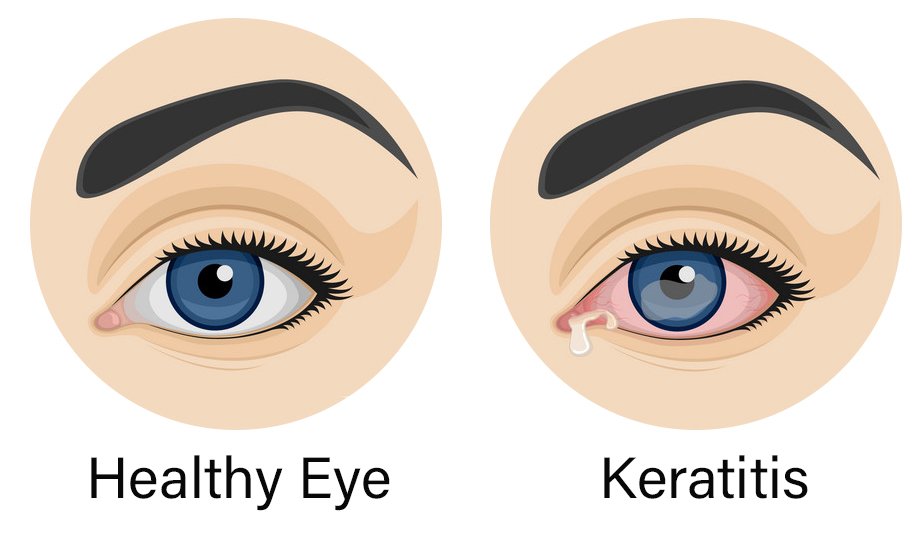 Corneal Ulcer (Keratitis) – Kiran Eye Hospital