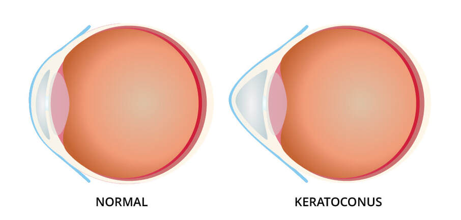 Keratoconus