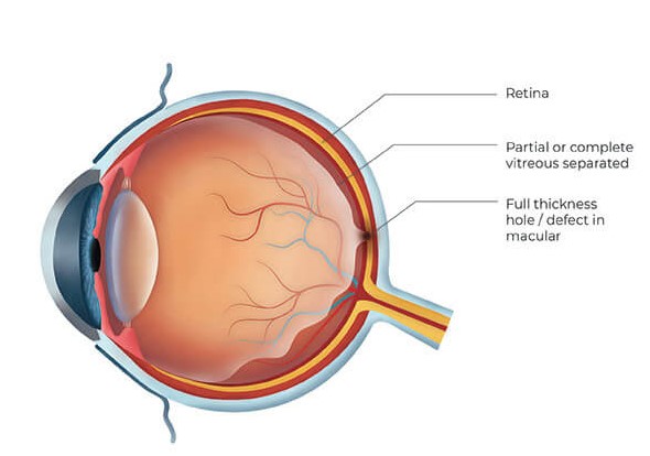 Macular Hole