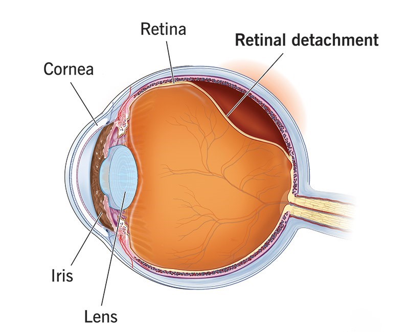Retinal Detachment
