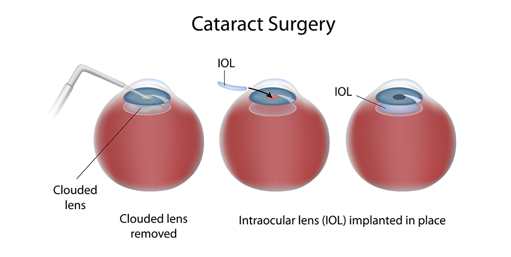 Cataract Surgery