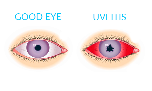 Uveitis