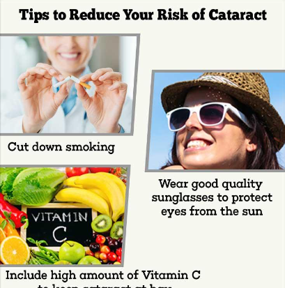 Understanding Cataracts: Causes, Symptoms, Recent Advances in Treatment, and Prevention