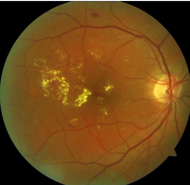 Diabetic Retinopathy
