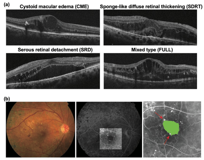 Diabetic Macular Edema (DME)