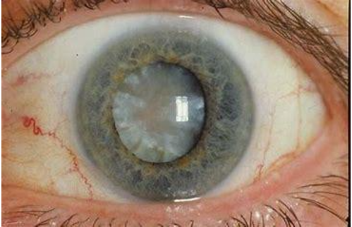 Cataracts