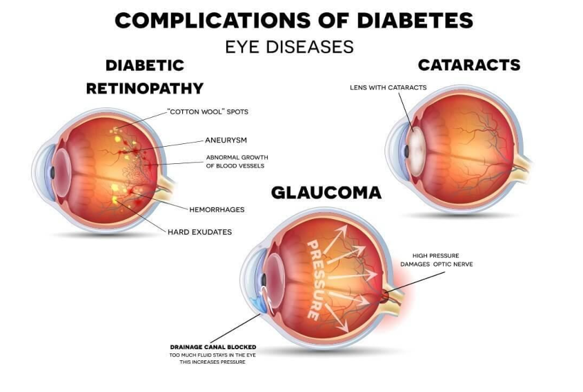 Diabetes – The Silent Threat to Vision Loss