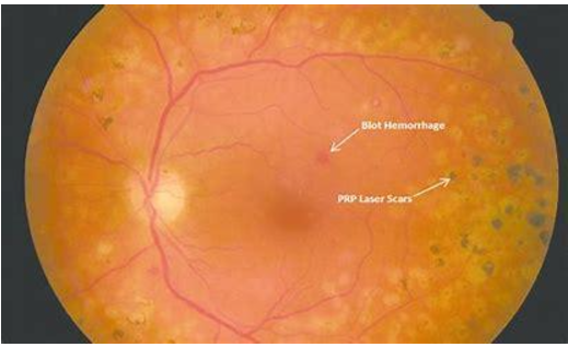 PRP-Laser Therapy (Photocoagulation)