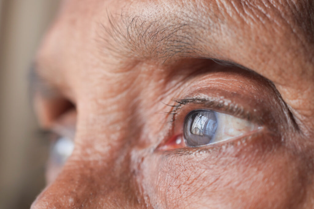  Cataract Surgery in Kanakapura Road