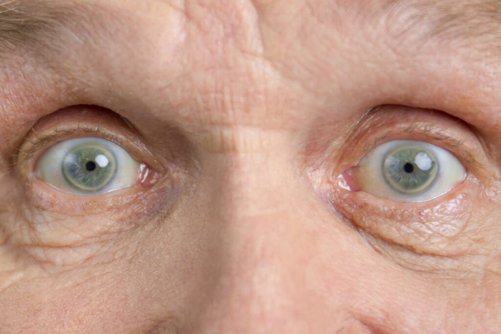 Cataract Surgery in Kanakapura Road