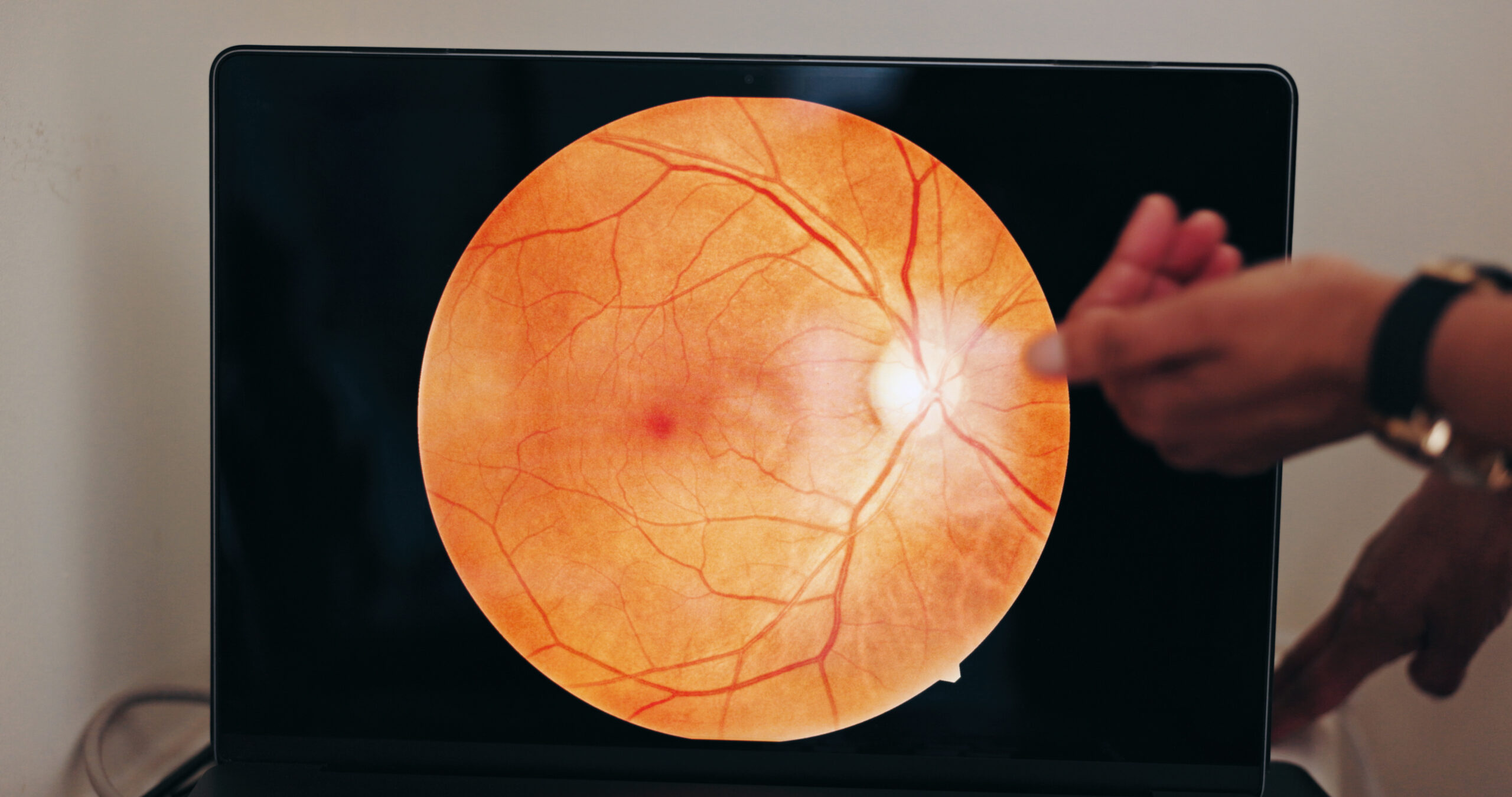 Floaters and Flashes: Harmless or a Sign of Retinal Detachment?