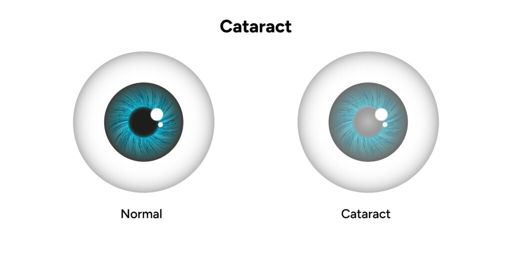 Cataract Surgery in JP Nagar Bangalore