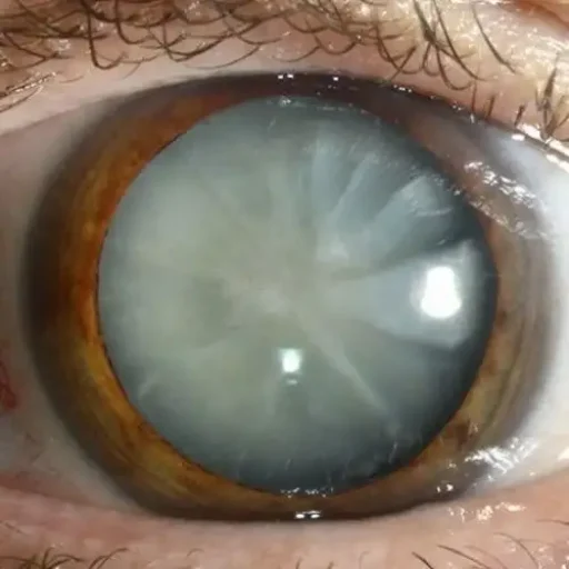 cataract cataract